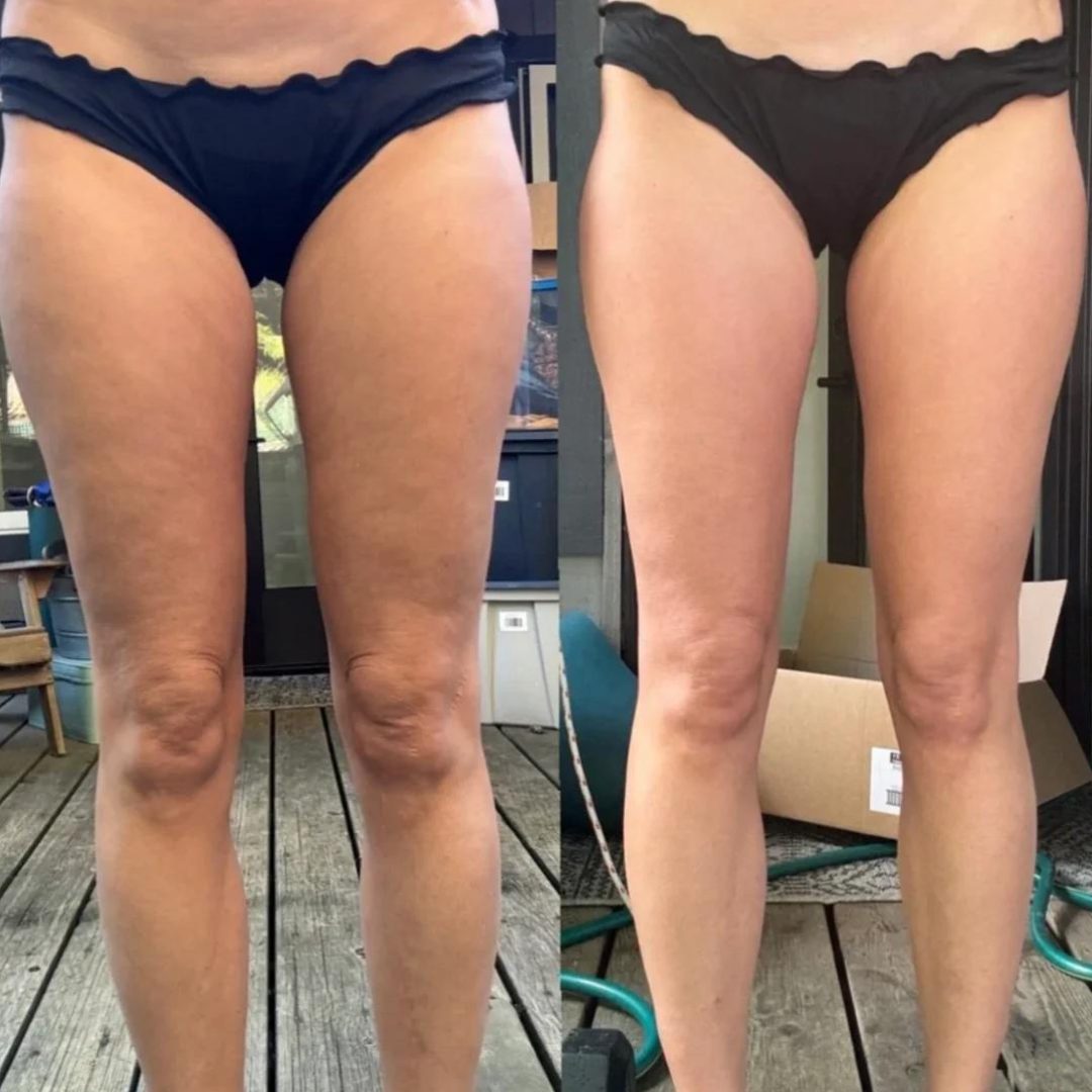 Anti-Cellulite-Gerät "Smoother"